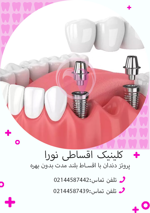 پروتز دندان با اقساط بلند مدت بدون بهره